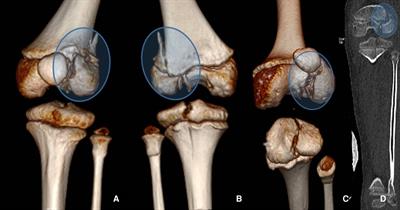 Bone wax in the treatment of partial epiphysiodesis of distal femoral growth plate: Case report at 10-year follow-up